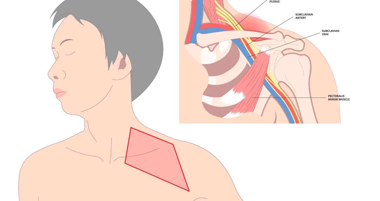 Pleksus Yaralanmaları Nedir?