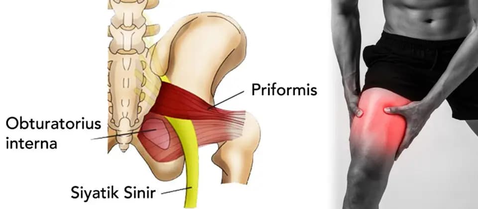 Priformis Sendromu Nedir?