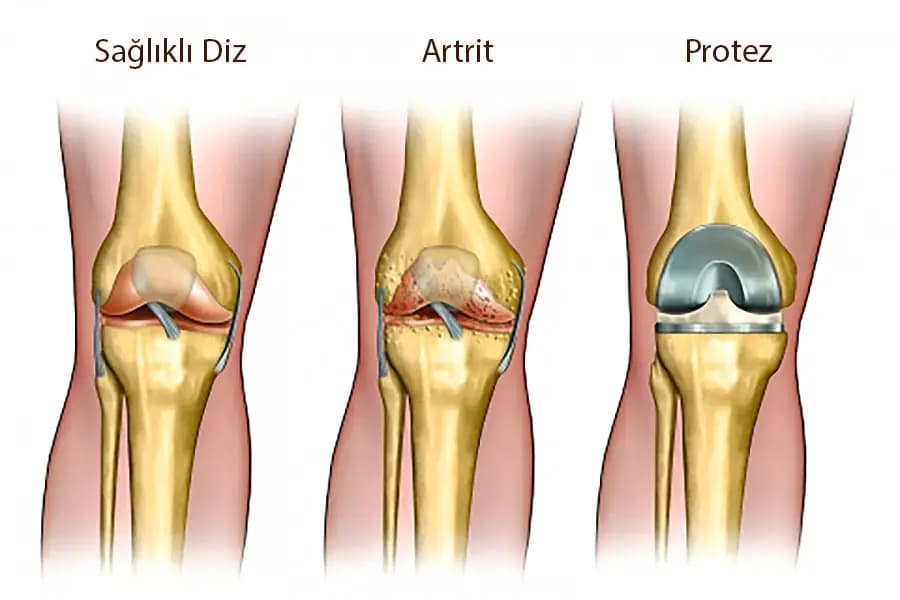 Total Eklem Değiştirme Cerrahisi Nedir?