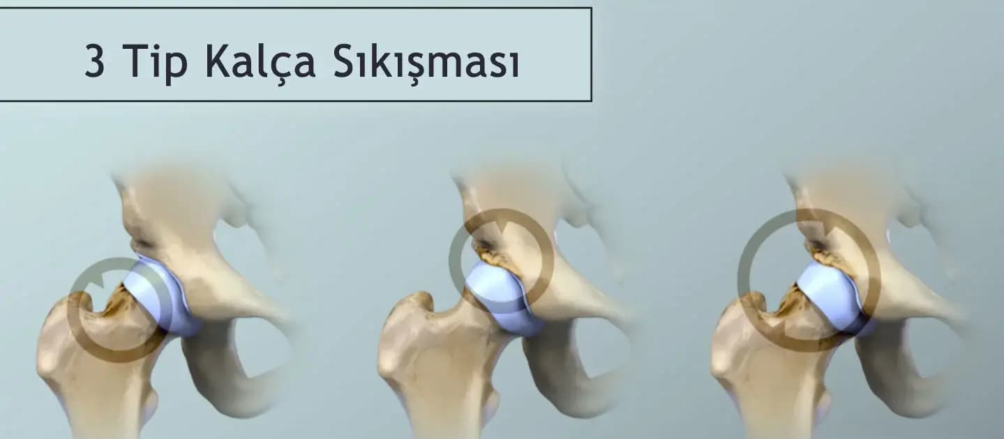 Kalça Sıkışması (Femoroasetabular Sendrom) Nedir?