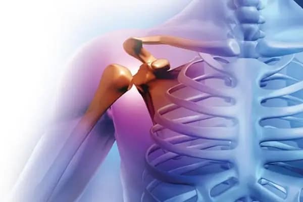 Omuz Kireçlenmesi Nedir?