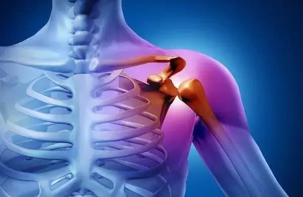 Omuz Sıkışması Nedir?