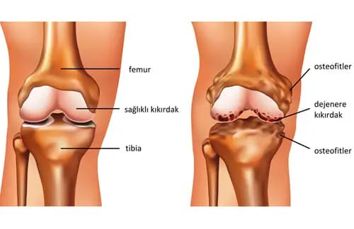 Diz Önü Ağrısı (Patellofemoral Sendrom) Nedir?