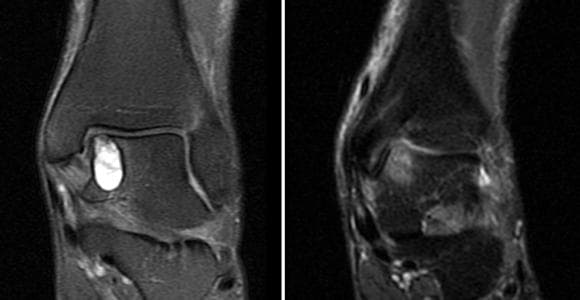 Ayak Bileği Lezyonu Talus Osteokondral