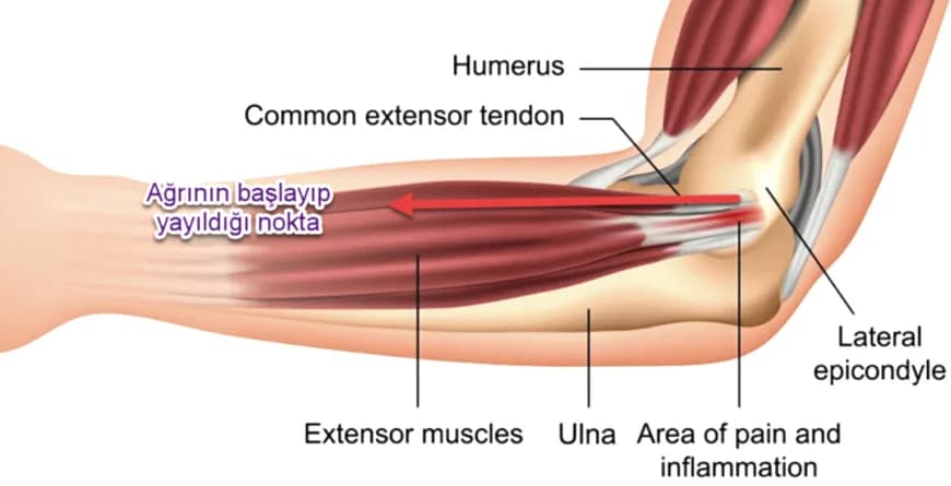 Golfçü Dirseği (Medial Epikondilit) Nedir?