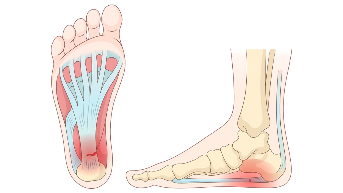 Plantar fasiit (fasciitis) nedir?