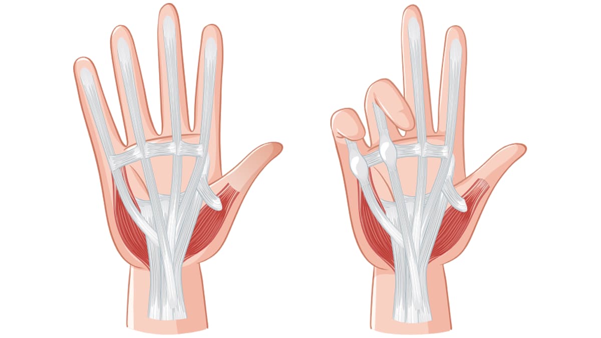 Dupuytren Kontraktürü​ Nedir?