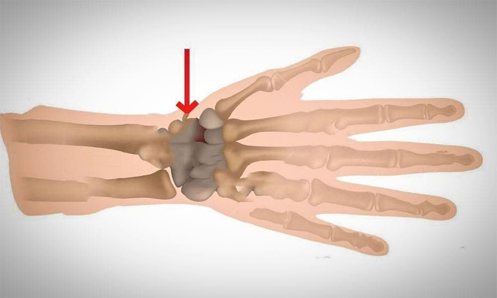 El Bileği Kırığı