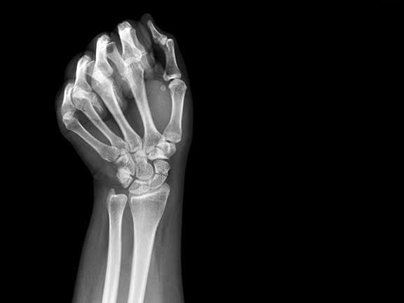 Skafoid Kırığı Belirtileri