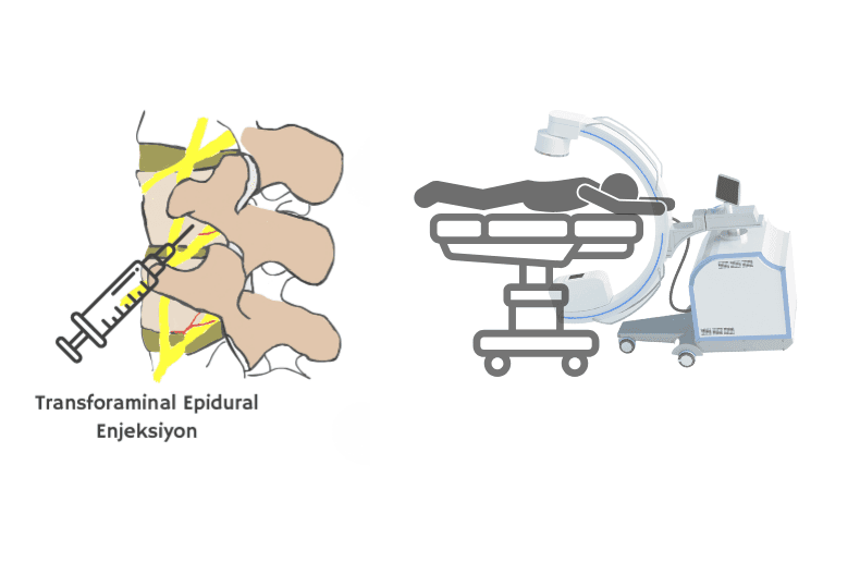 Epidural Enjeksiyon Nedir?