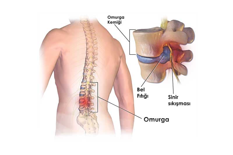 Lomber Diskopati Nedir?