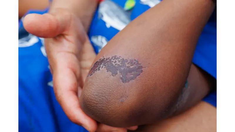 Olekranon Bursiti Nedir?