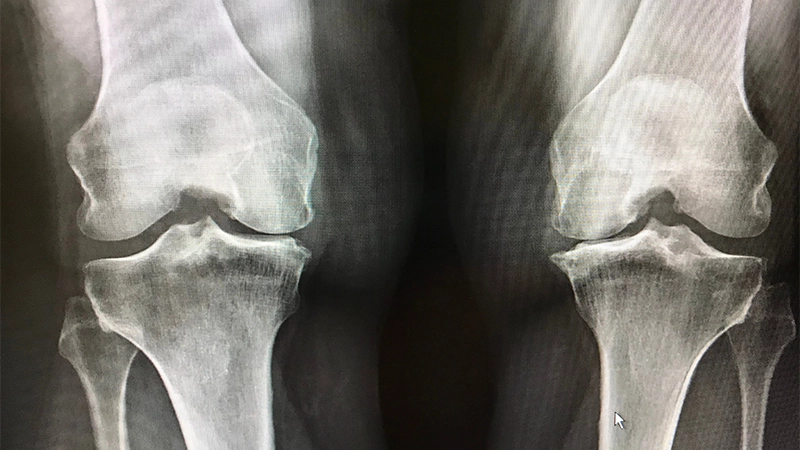 Knee Osteoarthritis