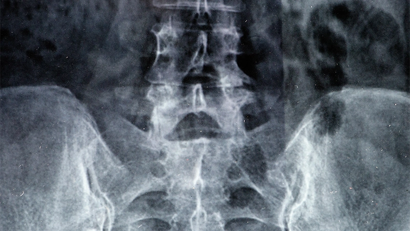 Kalça Kireçlenmesi Belirtileri