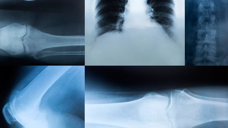 Kalça Kireçlenmesi