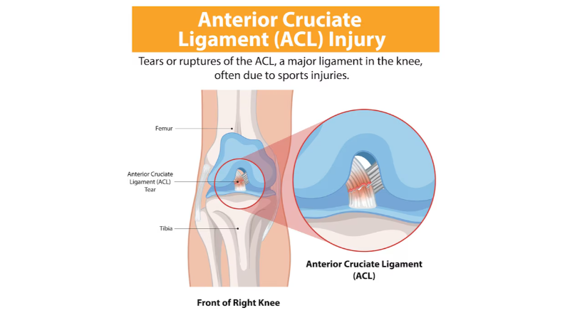 Symptoms of Posterior Cruciate Ligament Tear