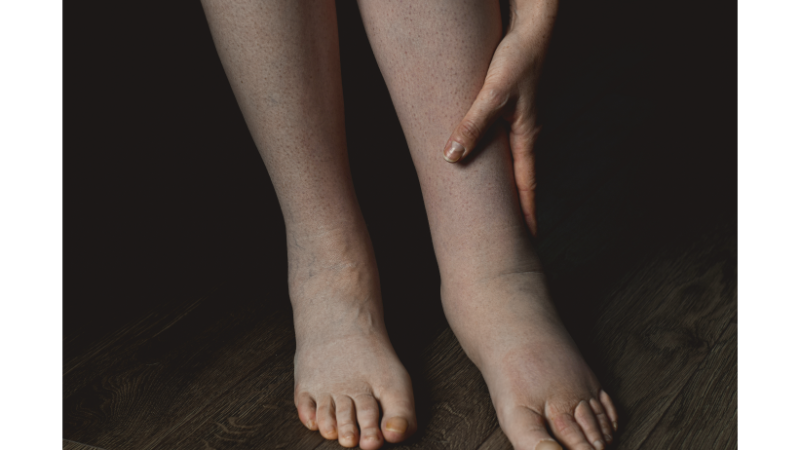 How Is Bone Marrow Edema Treated?