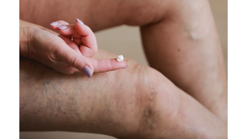 Dizdeki Ödem İçin Krem Kullanımı